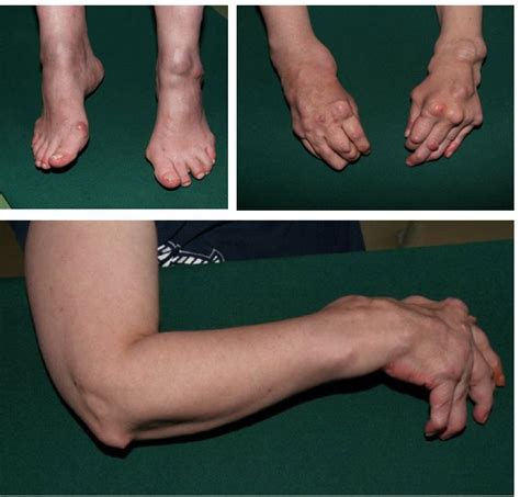 Extraskeletal Manifestations in Rheumatoid Arthritis - Clinical Cases ...