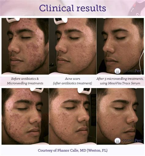 Acne Treatment Weston | Weston Medical Clinic & Cosmetic Center