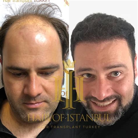 hair transplant turkey beard transplant hair transplant surgery