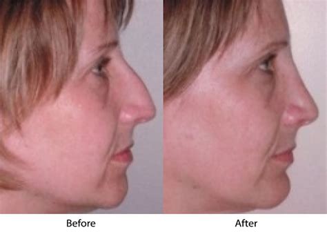 Nose Job in Los Altos, CA: Aesthetic & Functional Transformation