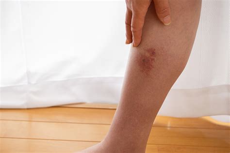 Essential Oils for Cellulitis: Benefits & How to Use Them