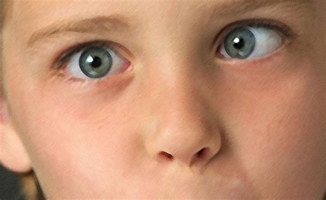 Škiljenje | Bambino.si - Portal za nosečnice in dojenčke