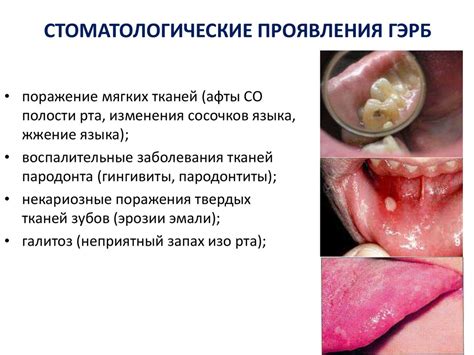 Внепищеводные проявления ГЭРБ - презентация онлайн