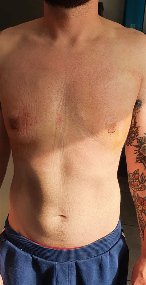 Chest Feels Tight After Gynecomastia Surgery at Mark Lola blog