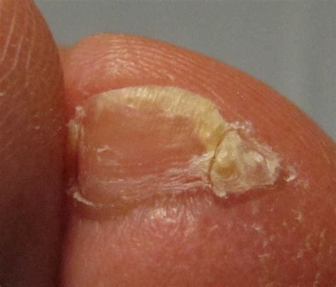 Toe tales | Memos from the Field