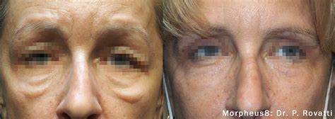 treatment   eye bags dark circles morpheus  los angeles