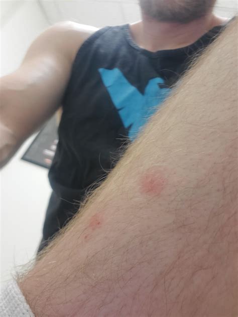 Any idea what these itchy bites are? : r/bugbites