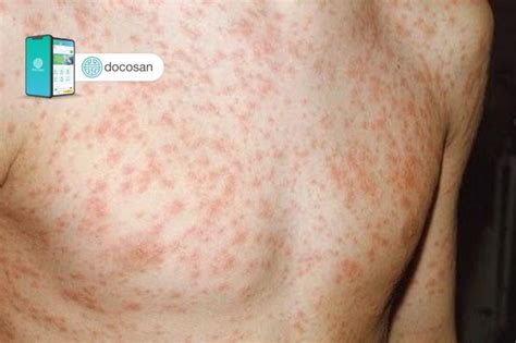 Bệnh sởi ở người lớn và những thông tin quan trọng cần biết | Doctor có sẵn