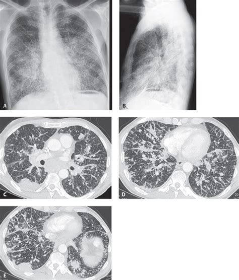 44 Combined Right Middle and Lower Lobe Atelectasis | Radiology Key