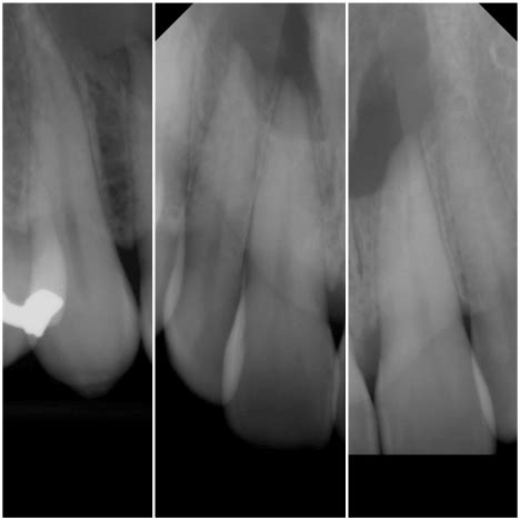 Nasopalatine duct cyst: A diagnostic dilemma
