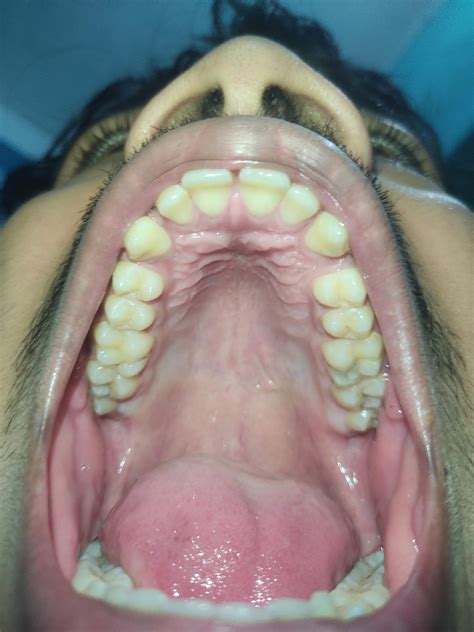 guy     normal palate  narrow palate rmewing