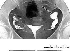 Sactosalpinx — the reasons, symptoms, treatment