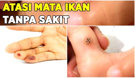 tumbuh mata ikan  tangan  langkah  bisa atasi penyakit mata ikan