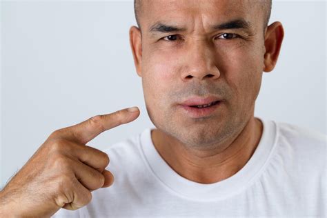 The man has facial swelling due to an allergic reaction to triggers