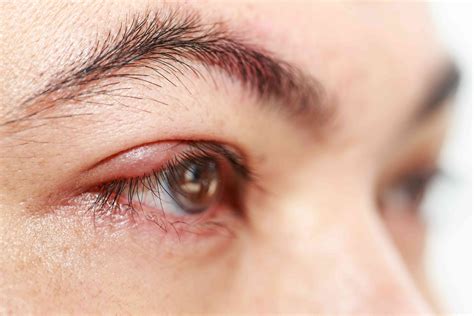 how to get rid of a stye faster
