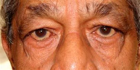 Turned-In Eyelid (Entropion) | Oculofacial Society