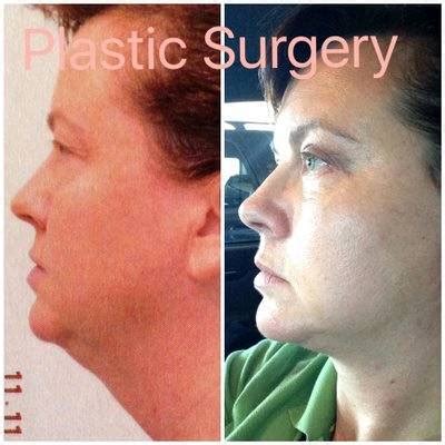 jowl lift facelift info prices  reviews qa