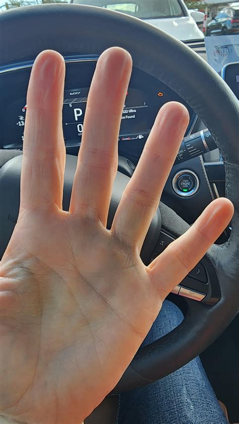 Bruised swollen hands : r/lupus