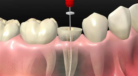 What is tooth depulpation, depulpation (pulp removal) of a tooth during ...