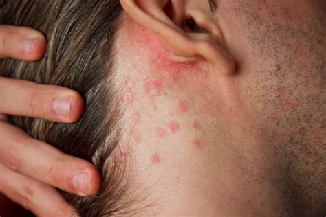 Dermatitis - E45