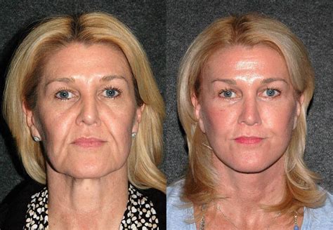 Deep plane facelift before after dr andrew jacono – Artofit