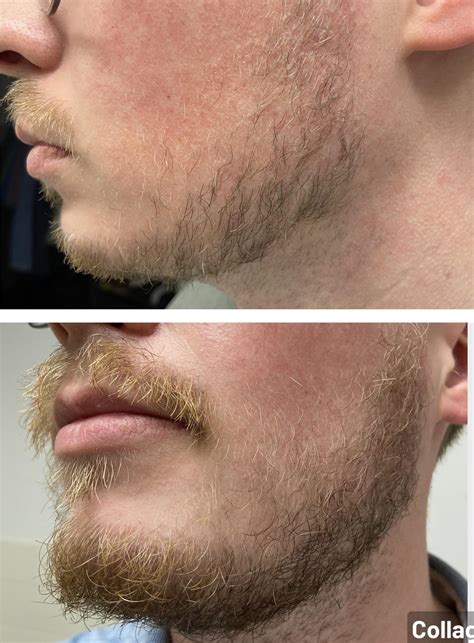 Slow gainer. 1 year of inconsistent use. Didn’t think I had made any ...