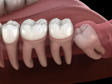 p  roof  mouth  wisdom tooth extraction infoupdateorg