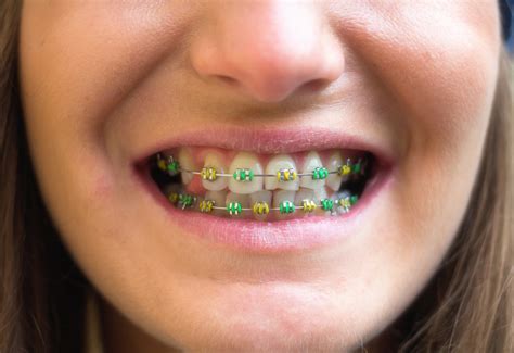 Cool Braces Color Combinations Artman Braces Color Bands Multicolored