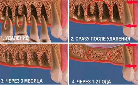 Cicatrização Da Gengiva Após Extração - Placa branca no orifício da gengiva após a extração do dente: o que é, foto