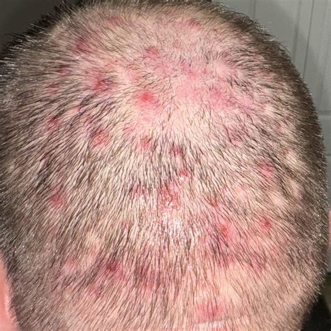 Scalp Folliculitis Cure Folliculitis Decalvans