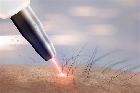 Laser Hair Removal Idaho Falls - www.inf-inet.com