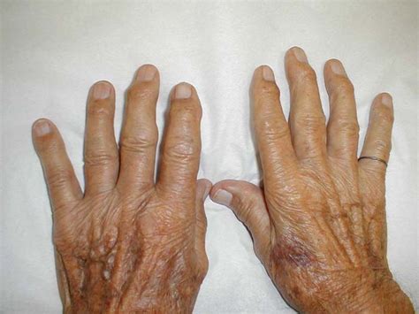 heberdens nodes bony prominences  distal interphalangeal grepmed