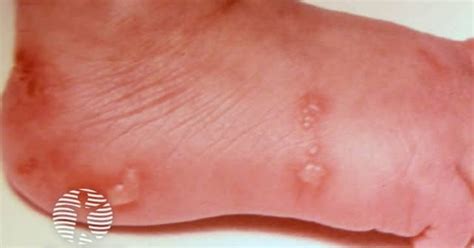 Neonatal herpes simplex2 image 