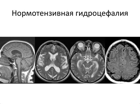 Гидроцефалия