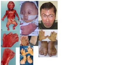 Clinical appearance of RAB23 mutation-positive Carpenter syndrome at ...
