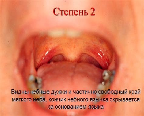 Аденоиды у детей. Чем опасно и как лечится - Лор-нэт