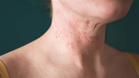incontinence  dermatitis iad