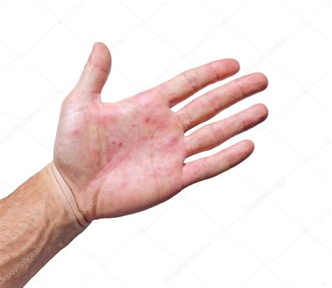 Palm patient erythema in red spots from inflammation Stock Photo by ...