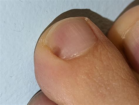 Melanoma under nail or something else? : r/DermatologyQuestions
