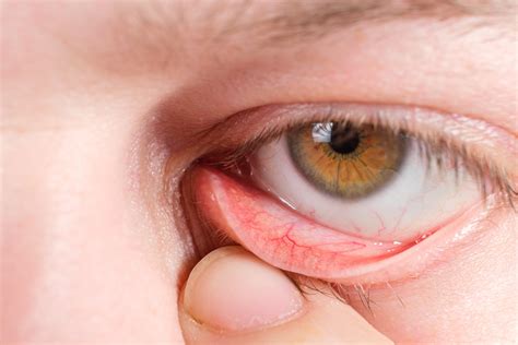 Dry Eye (MGD) - Helix Medspa
