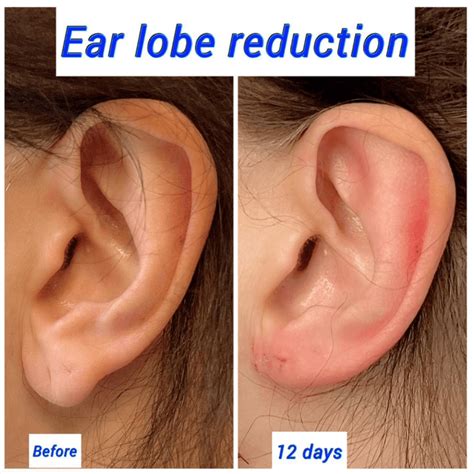 earlobe reduction surgery ear surgery harley clinic
