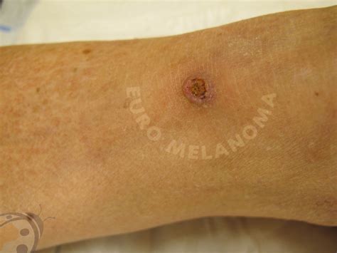 Spinocellulair of plaveiselcelcarcinoom - Euromelanoma
