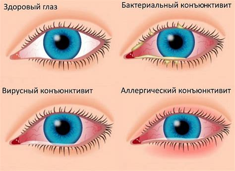 Запальні захворювання очей: список, симптоми і лікування