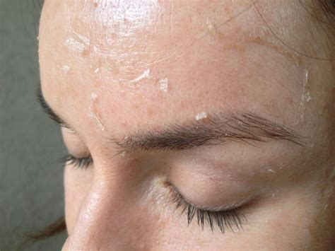 Skin Peeling After Hot Shower at Lester Watkins blog