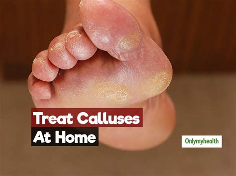 how to get rid of callus on toe