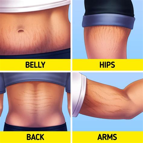 simple definition  stretch marks     rid   artofit