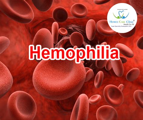 Haemophilia: Causes, Symptoms and Homeopathic Treatment