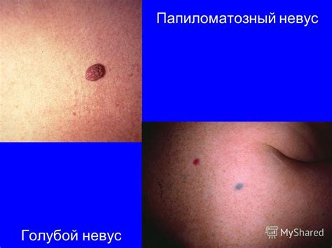 Презентация на тему: "Особенности течения меланомы на голове и шеи ...
