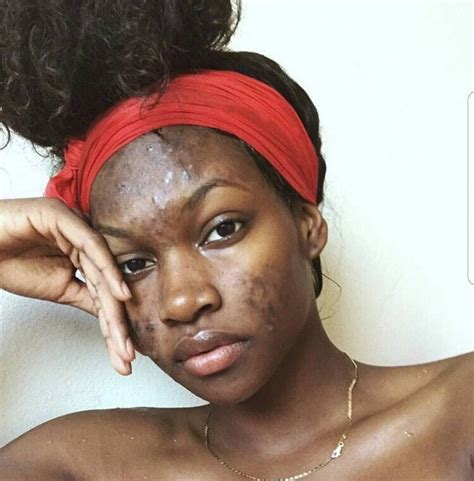 clear skinned people lived  acne   day