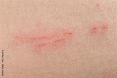 Texture Of Human Skin And Scratch Stock Image Colourbox ...